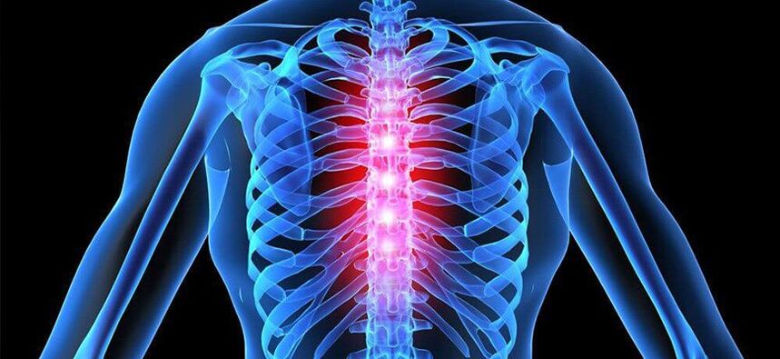 Akuter Schmerz ist charakteristisch für eine Verschlimmerung der Osteochondrose der Brustwirbelsäule. 