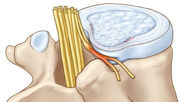 Die bei der thorakalen Osteochondrose auftretenden Vorwölbungen der Bandscheibe komprimieren die Nervenenden.