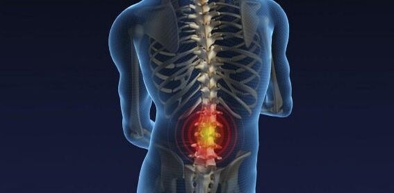 Rückenschmerzen mit lumbaler Osteochondrose
