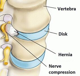 Osteochondrose der Gebärmutterhalsregion