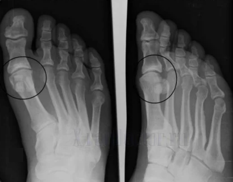 Diagnose einer Arthrose