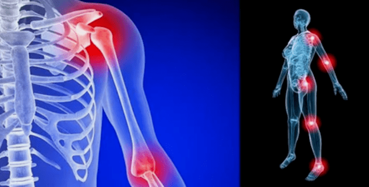 Gliedmaßenverformung bei Arthrose
