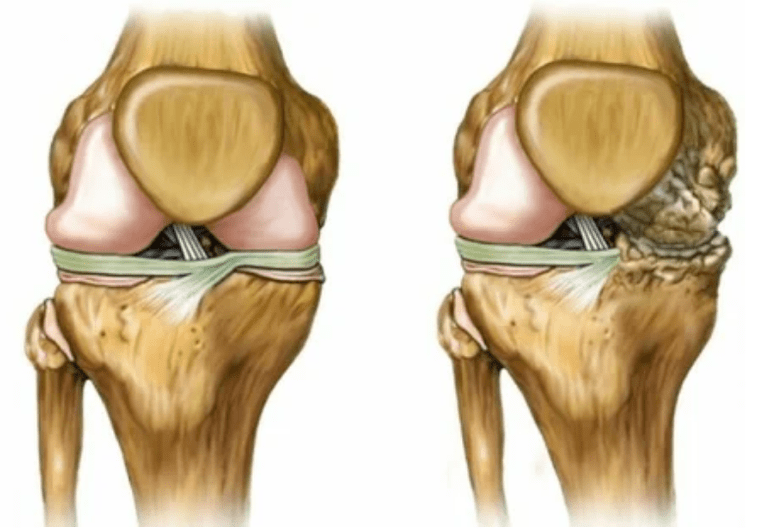 Stadien der Arthrose