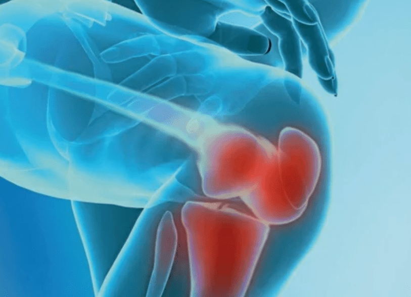Was ist Arthrose