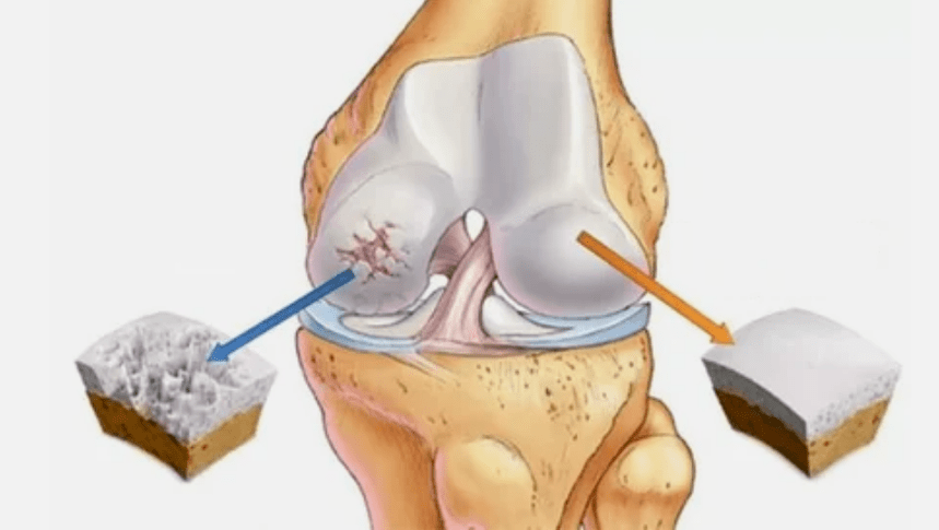 Wie sich Osteoarthritis entwickelt