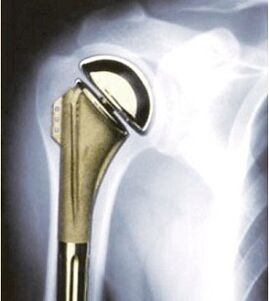 Schulterersatz bei Arthrose