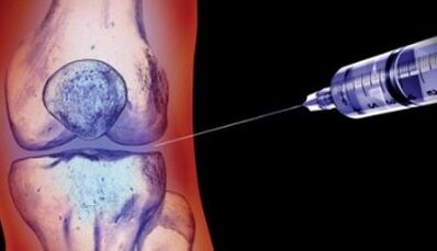 Methoden zur Behandlung von Gelenkarthrose