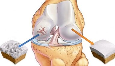 Ursachen für Arthrose der Gelenke