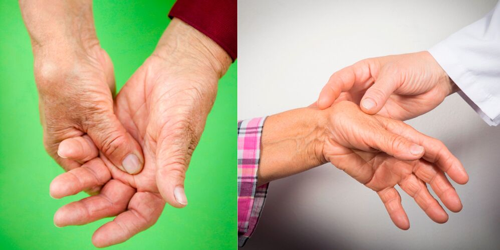 Schwellungen und Schmerzen sind die ersten Anzeichen von Arthritis der Hand