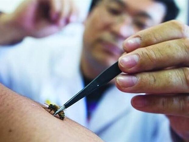 Apitherapie bei zervikaler Osteochondrose