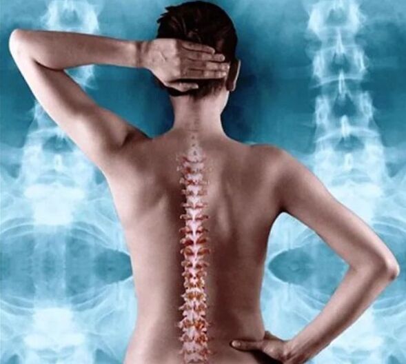 spinale und thorakale Osteochondrose