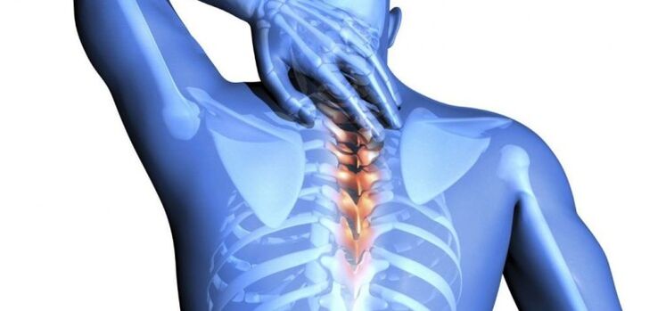 Schädigung der Wirbelsäule als Ursache für Schmerzen zwischen den Schulterblättern